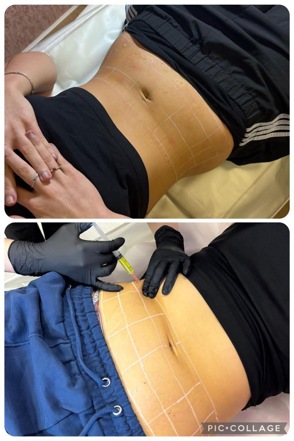 Placeholder image for the fat dissolving treatment service